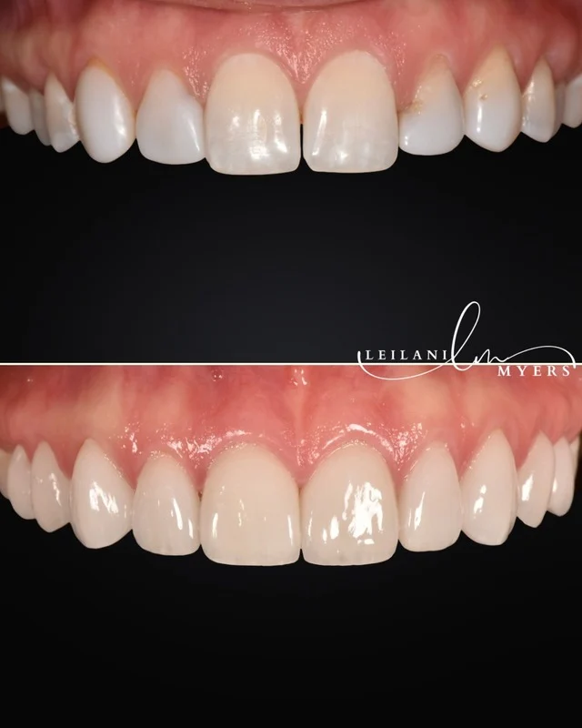 Porcelain Veneers - Image 1