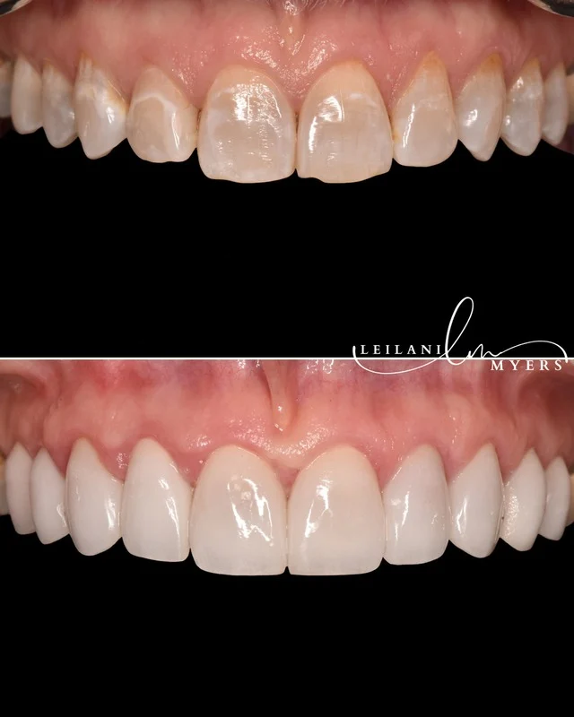 Porcelain Veneers - Image 1