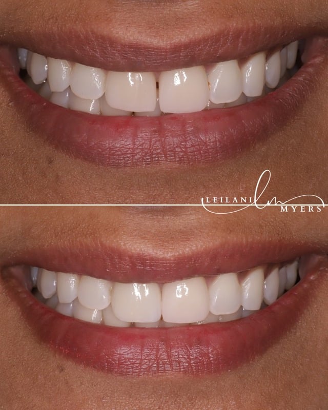 Veneer - Image 1