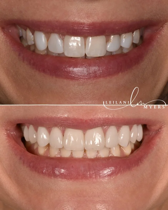 Invisalign - Image 1